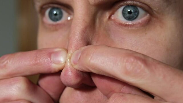 Man pressing red pimple with fingers. A guy squeezes a pimple. Inflammation on face. Visit to dermatologist. Pimple on nose. Pimples on face. Close-up