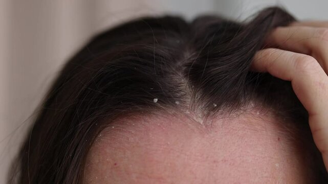 The woman found dandruff on her head. Closeup dandruff flakes on the scalp. 4K, slow motion.
