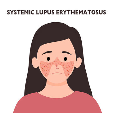 systemic lupus erythematosus. Young woman with the typical butterfly rash in lupus. SLE. skin disease