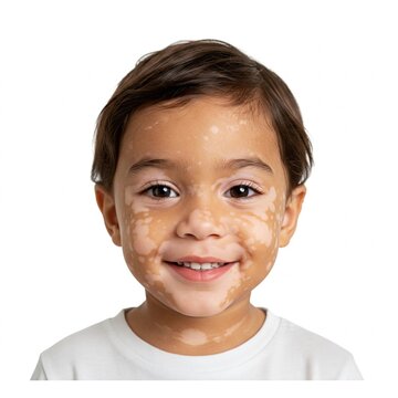 Pessoas com vitiligo