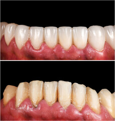 emax ceramic veneers