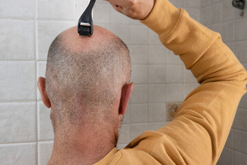 Man using a microneedle roller on his head. The dermarolling process aims to improve hair health...