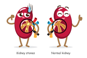 Kidney stones and normal kidney . Funny medical renal cartoon characters . Isolated white background . Vector .