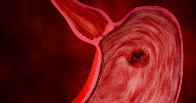 Gastric cancer. Noncommunicable diseases or NCDs. Gastrointestinal ailments from eating junk food. Stomach pain, stomach ulcers from acid reflux. 3D Rendering	