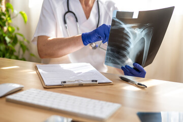Female doctor wearing blue gloves, carefully examining a shoulder x-ray at her desk in a medical...