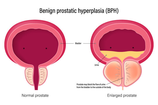 Benign prostatic hyperplasia (BPH). Comparison between normal prostate and enlarged prostate. Male reproductive system disease.