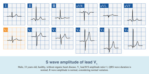 When the ratio of R wave amplitude to S wave amplitude in lead V1 is greater than 1, it indicates an increase in the excitation potential of the right ventricle during overall ventricular excitation.
