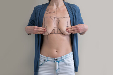 woman patient with medical surgical marks drawn on chest for plastic surgery preparation, medical mammoplasty, mastopexy breast enlargement, on white background