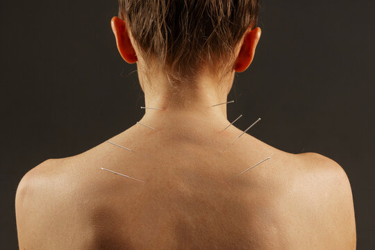 Acupuncture, needles and treatment of body in healthcare, healing muscle and back pain relief. Patient, anatomy and dry needling physiotherapy to relax person at salon and holistic care for injury.