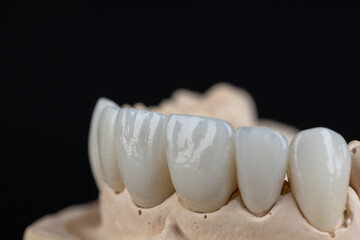 Dental health care. Ceramic zirconium in final version. Close up dental zircon ceramic crowns on...