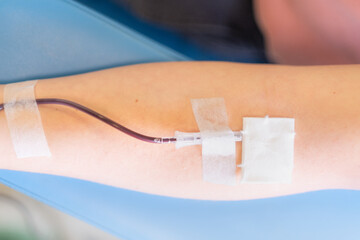Top view of the detail of an arm of a volunteer donor pumping blood. It is a blood donation bank,...