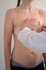 Plastic surgeon marking womans breast with pen before surgery, patient standing topless while doctor draws incision lines on chest, medical aesthetic procedure, medical mammoplasty, mastopexy 