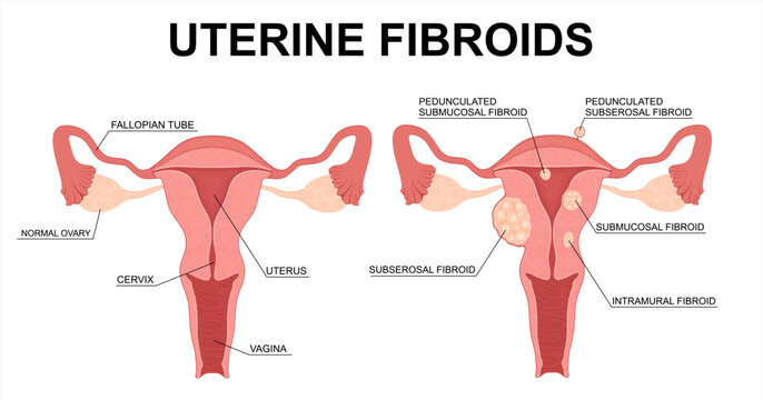 Uterine Fibroids Types. Medical Vector Illustration