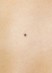 Tick on human body. Selective focus.
