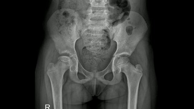 Pediatric Pelvis X-ray Showing Bone Structure and Development