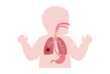 Aspiration pneumonia poster