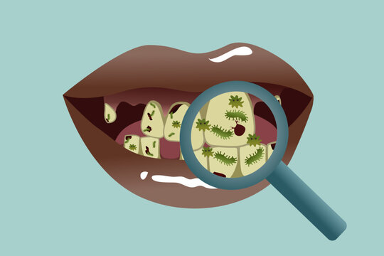 Depiction of Unhealthy Teeth with Cavities, Tartar, Bacteria, and Tooth Loss &ndash; Useful for Dental Care Awareness Content