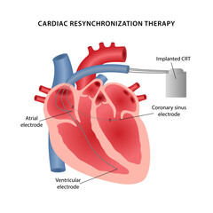 Cardiac resynchronization therapy. Medical illustration of the layout of three electrodes placement diagram for a pacemaker. Vector illustration in a flat style isolated on white background
