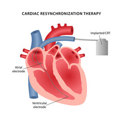Cardiac resynchronization therapy. Medical illustration of the layout of two electrodes placement diagram for a pacemaker. Vector illustration in a flat style isolated on white background