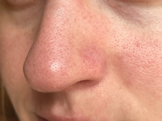 Obraz premium Close-up of natural female skin with visible pores, texture and redness on cheek and nose area. Realistic skincare, dermatology and anti-aging visual