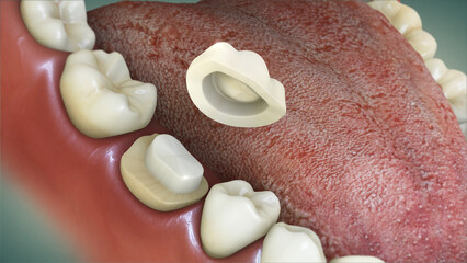 Dental crown placement over tooth. 3D illustration