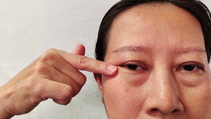 portrait the wrinkle and Flabby skin beside the eyelid, swelling and ptosis under the eyes, dark spots and blemish on the face of the woman, health care and beauty concept.