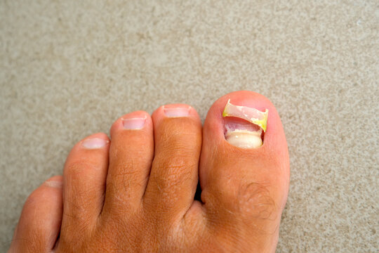 Removed old fallen off nail big toe nail after mechanical injury damage under the nail, subnail