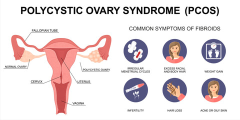 PCOS &ndash; Polycystic Ovary Syndrome Symptoms. Uterus Cross-Section and Polycystic Ovary.  Medical Vector Illustration. 