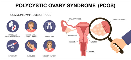 PCOS &ndash; Polycystic Ovary Syndrome Symptoms. Uterus Cross-Section and Polycystic Ovary.  Medical Vector Illustration. 