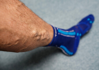 Varicose veins. Phlebology and DVT. Varicose veins on leg of man. Varicosity on legs, spider veins,...