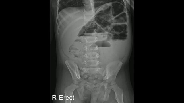 Pediatric Abdominal Erect X-Ray for Obstruction Evaluation