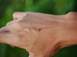 someone's hand is being bitten by a mosquito