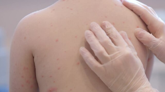 The Back of a Child Who is Affected by a Skin Condition chickenpox That Requires Medical Attention and Care