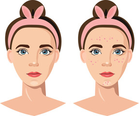 skin type of woman with acne and clear skin