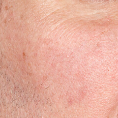 A man with a shaved face has a red patch on his cheek