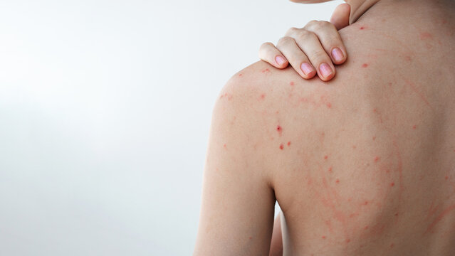 female back and shoulders of a young woman with pimples and acne on skin on a white isolated background. Body of a girl with problematic skin close-up