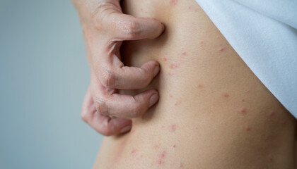 Fototapeta premium Rash With Bumps, Scabs. Females sunburned back, psoriasis Skin. Skin allergic to cosmetics and red skin.
