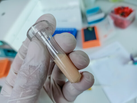 Doctor hold Lipemic blood sample test tube. Test tube for high triglyceride contain blood sample. Lipid profile diagnosis