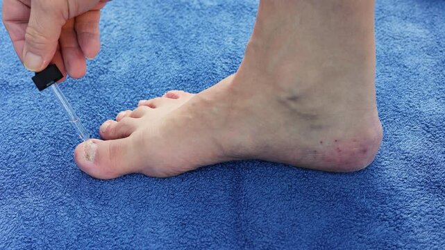 Man Treats Fungal Nail Infection - Applying Antifungal Ointment to Toenail Fungus on Big Toe With Eye-dropper and Brush