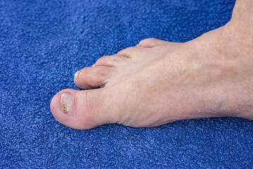 Unhealthy Senior Male Foot in Profile with Toenail Fungal Nail Infection (Onychomycosis) on Big Toe