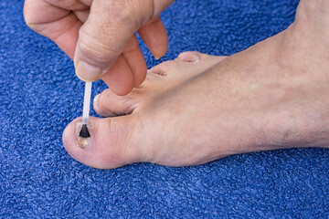 Antifungal Ointment Applied to Big Toe Infected with Toenail Fungus - Onychomycosis Self Care
