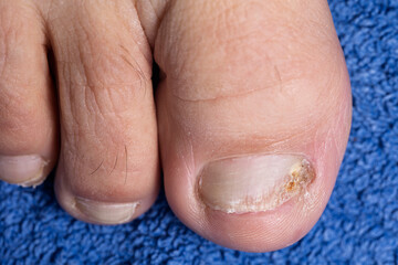 Close-Up of Discolored and Damaged Big Toe Toenail with Fungal Nail Infection (Onychomycosis) on Blue Background