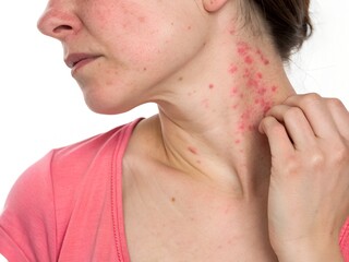 Fototapeta premium Woman Experiencing Skin Irritation on Neck Due to Allergic Reaction