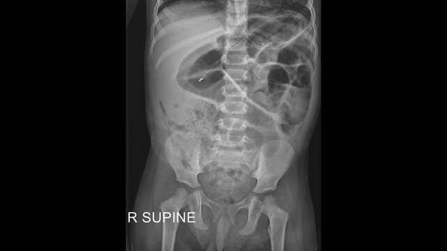 Child Abdomen Supine X-Ray for Pediatric Abdominal Diagnosis