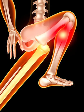 Disorders W sit injury bow leg genu valgum varum flat duck out turn inward varus club skew birth in toeing child baby kids knock knees slew foot valgus ankle palsy hip pain