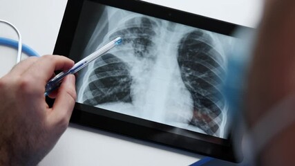 doctor with face surgical mask holding lungs radiography scan showing part infected with bacterial pneumonia.man in blue suit with stethoscope on neck holding tablet pointing with hand.chest x ray