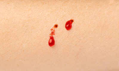 Snake bite on skin, snakebite or cat bite marks close up. Two small fresh blood drops on hand