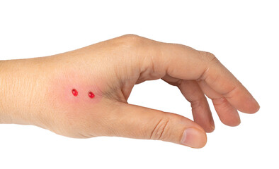Snake bite on skin, snakebite or cat bite marks close up. Two small fresh blood drops on hand