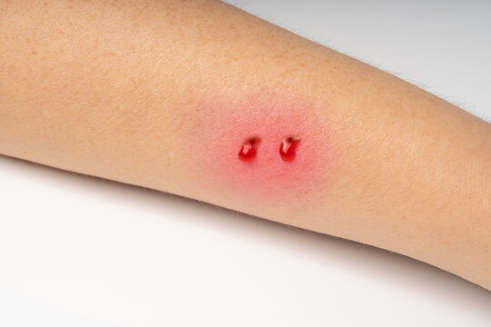 Snake bite on skin, snakebite or cat bite marks close up. Two small fresh blood drops on hand