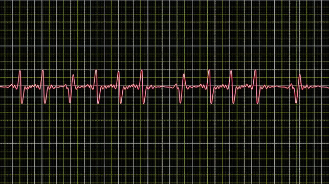 ECG with supraventricular premature beats and short paroxysms of neon atrial fibrillation